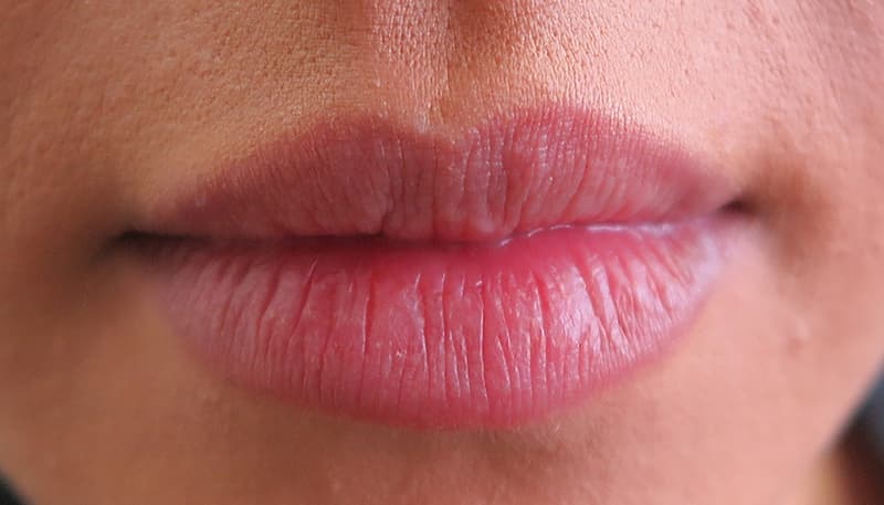 Adelaide Lip Fillers
