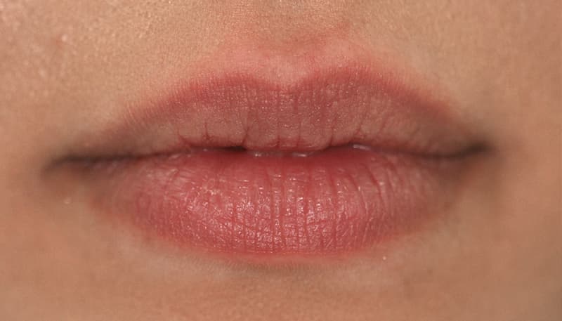 Adelaide Lip Fillers